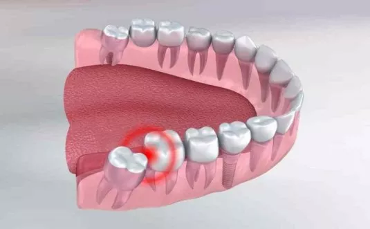 Οι Clear Aligners λειτουργούν πραγματικά για όλους τους τύπους χαμόγελου;